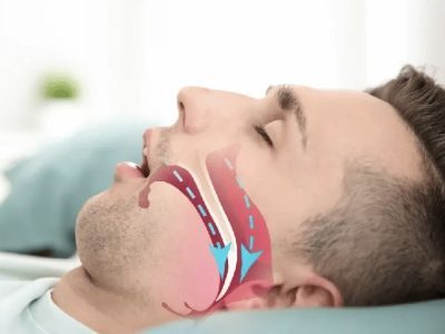 آپنه خواب ممکن است به مغز آسیب بزند و پیری را تسریع کند